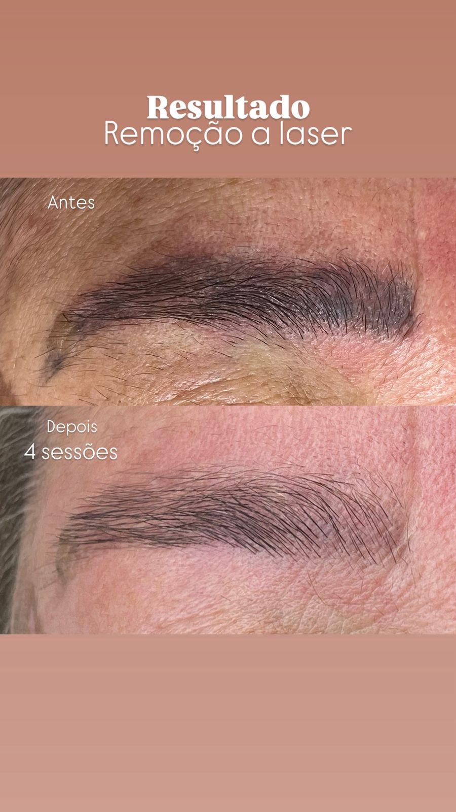 Resultado real — remoção a laser